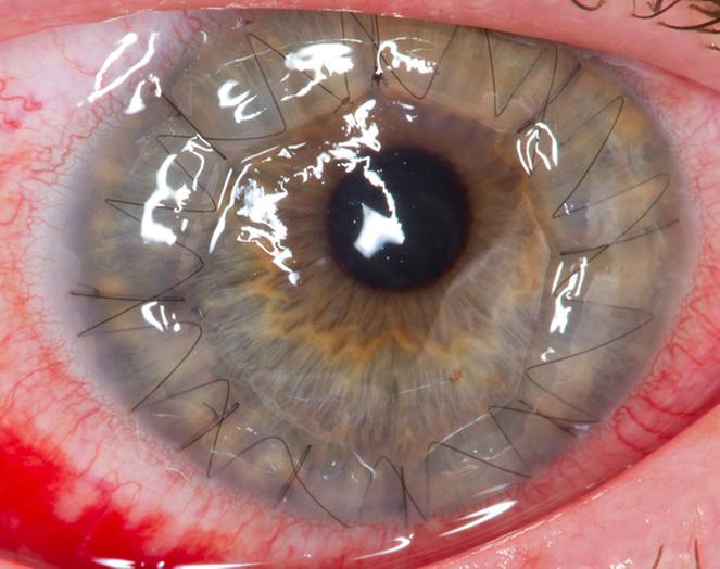File: Um olho humano 1 dia após uma córnea transplant.jpg