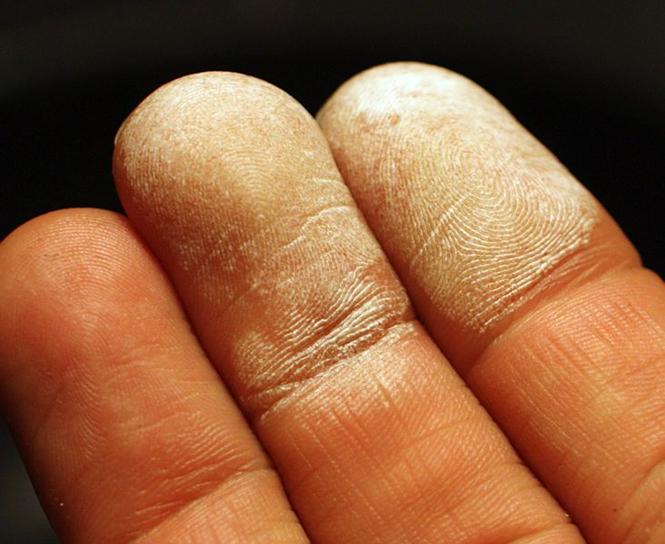 File:Hydrogen peroxide 35 percent on skin.jpg