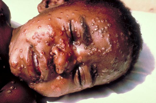 https://upload.wikimedia.org/wikipedia/commons/thumb/7/70/Smallpox.jpg/1280px-Smallpox.jpg